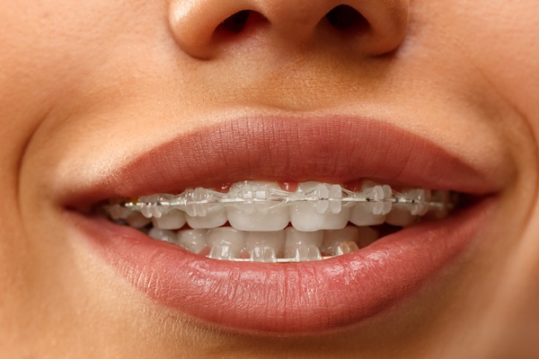 Things You May Not Have Known About Clear Braces